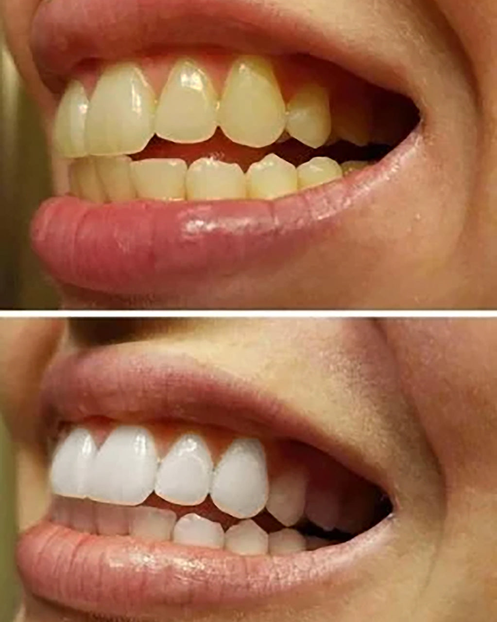 Teeth Whitening Set